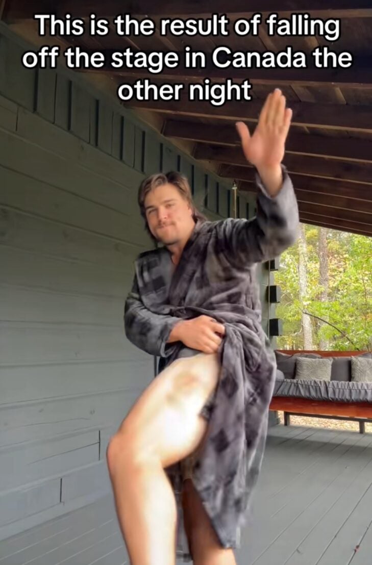 Gavin Adcock shows off the bruise off his leg from falling off the stage