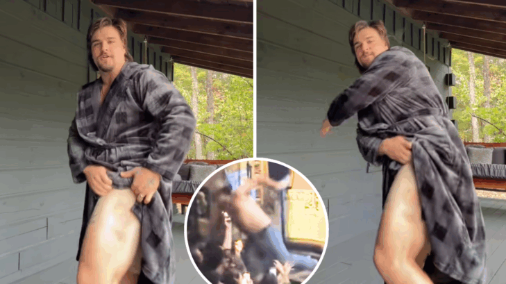 Gavin Adcock shows off the bruise from falling off stage